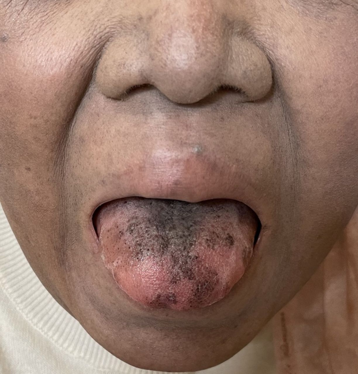 Minocycline-induced black hairy tongue and skin hyperpigmentation having black dots on tongue