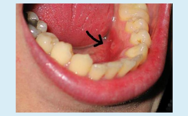 cancer mouth cyst