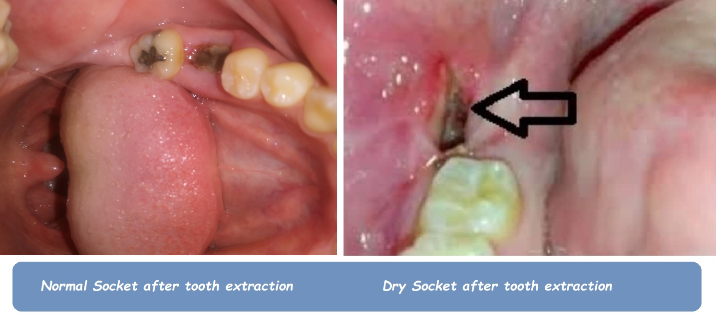 Normal Socket vs Dry Socket After Tooth Extraction: Key Differences, Symptoms, and Prevention