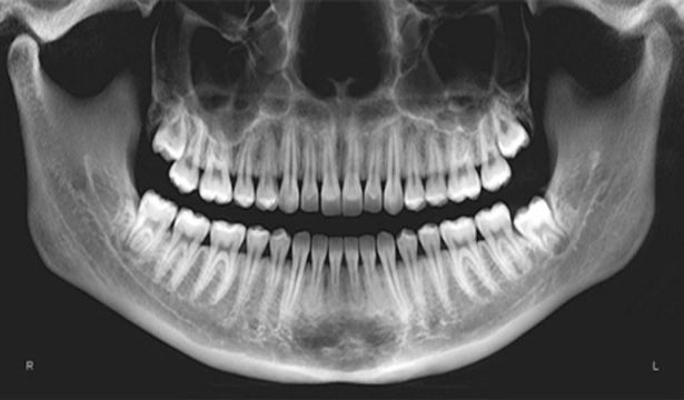 OPG-human upper and lower teeth