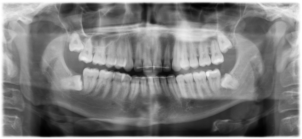 OPG showing impacted wisdom teeth on both usually causing molar teeth pain.