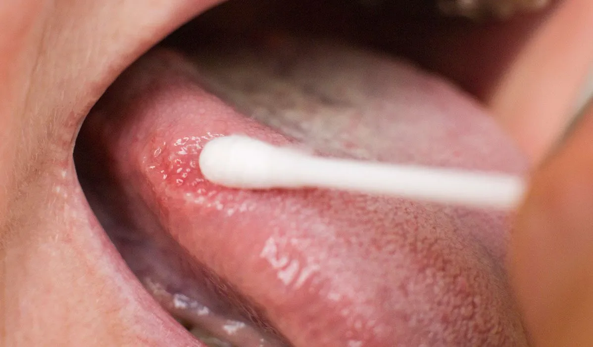 Oral Lichen Planus related black marks on tongue