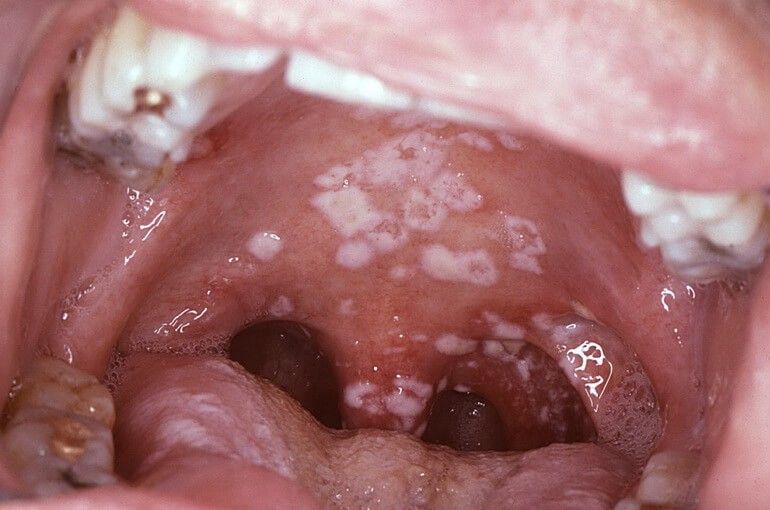 Oral Thrush: Causes, Symptoms, and Treatments - A Complete Guide