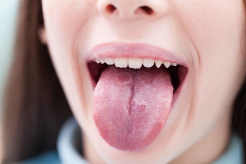 Oral Thrush: Causes, Symptoms, and Treatments - A Complete Guide