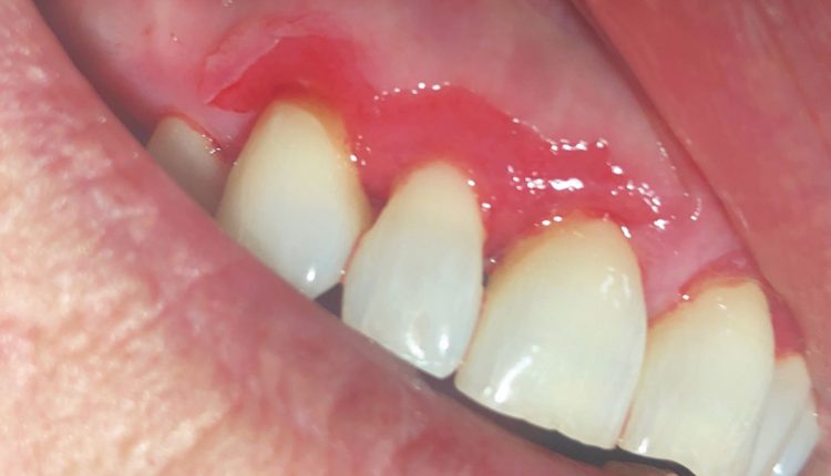 Oral lesion of desquamative gingivitis with symptoms of gums peeling