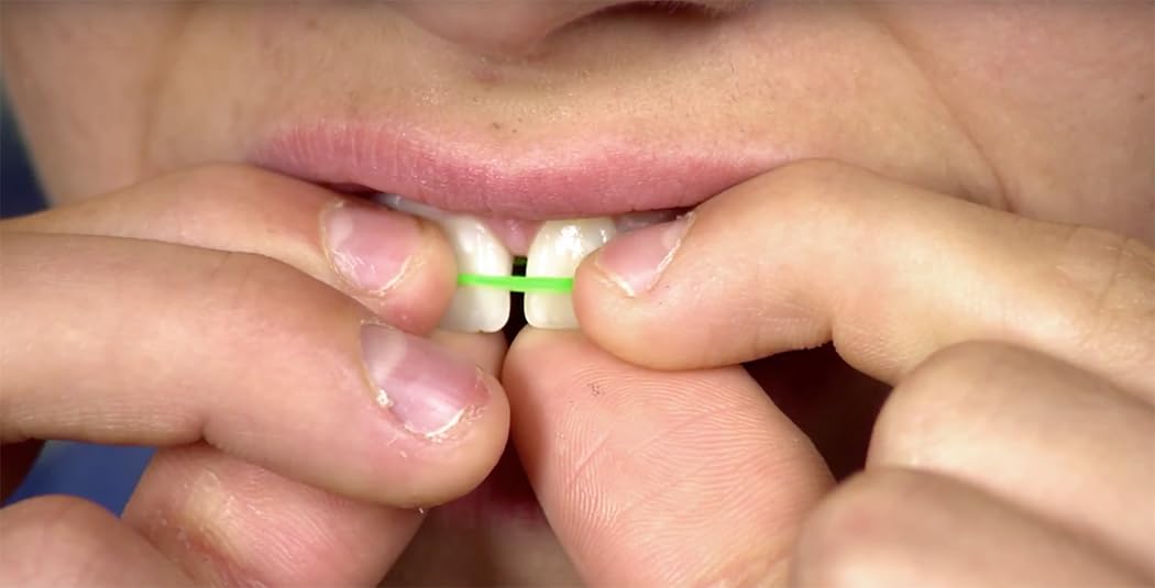 How to use Orthodontic bands to reduce gap between teeth naturally at home