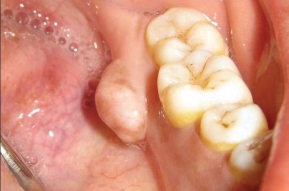 Osteoma-as lump under jaw line left side