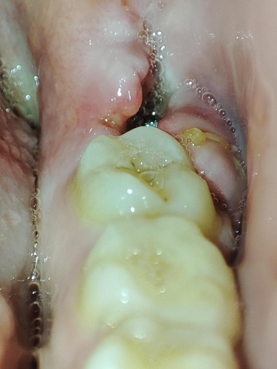 Patient having dry socket (infected gum) after wisdom tooth removal 