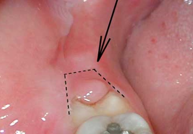 Pericoronitis-swelling at back gums due to wisdom tooth growth