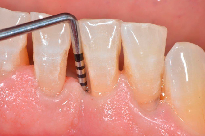 Periodontitis-bone loss aroud teth make hole in gums 