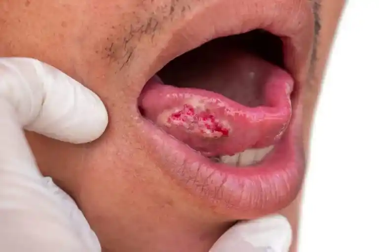 Mouth Cancer involving tongue picture