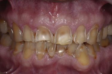 Enamel Erosion | Picture of Teeth Without Enamel: A Detailed Guide on Causes, Effects, and Treatment