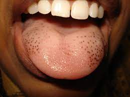  Pigmentation of the Fungiform Papillae of the Tongue in a Child Secondary to Iron Deficiency causing black spots on tongue