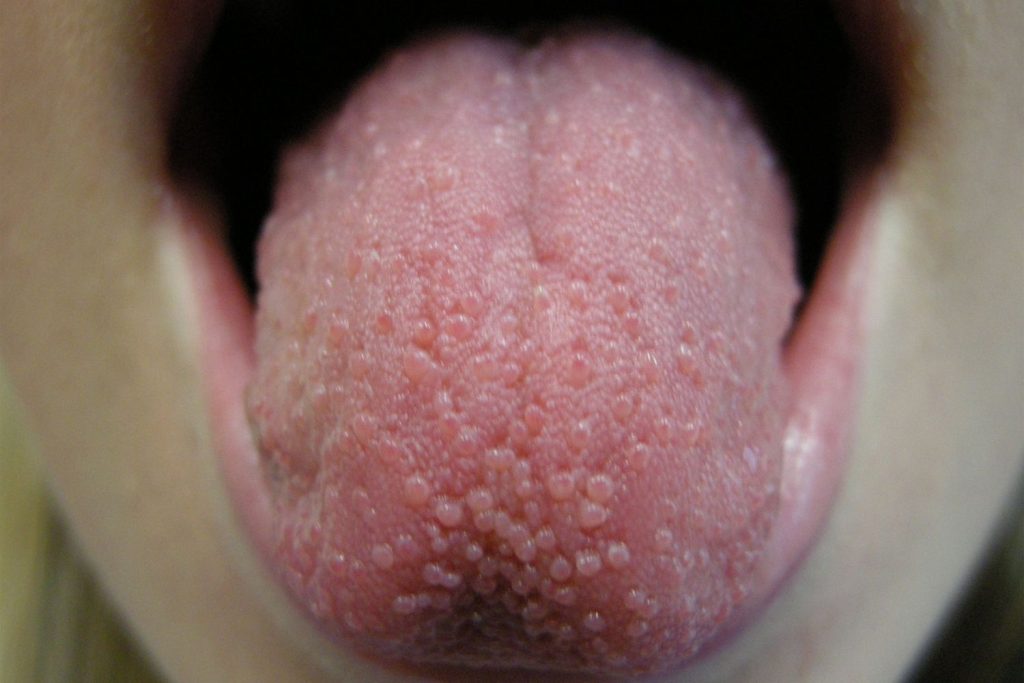 Pimple on Tongue? Transient lingual papillitis Understanding Causes, Treatment, and Prevention of Tongue Bumps