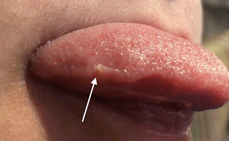 Pimple-on-Tongue-Understanding-Causes-Treatment-and-Prevention-of-Tongue-Bumps-Transient-lingual-papillitis-Transient_lingual_papillitis_annotated