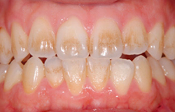 Plaque Deposition Turns Teeth Yellow