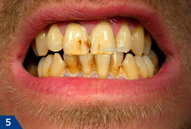 gingivitis plaque on teeth, Plaque on teeth become harder and darker if left unchecked