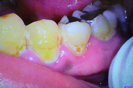 Poor Oral Hygiene Reason What Causes Yellow Teeth And Dental Decay.