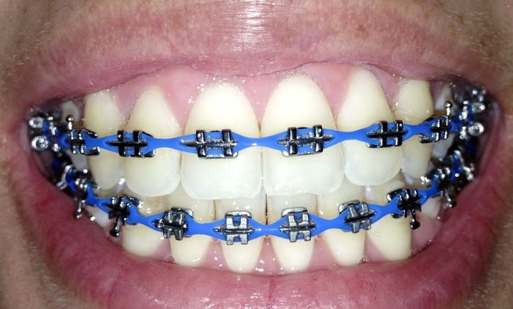 Power-chain-braces-color