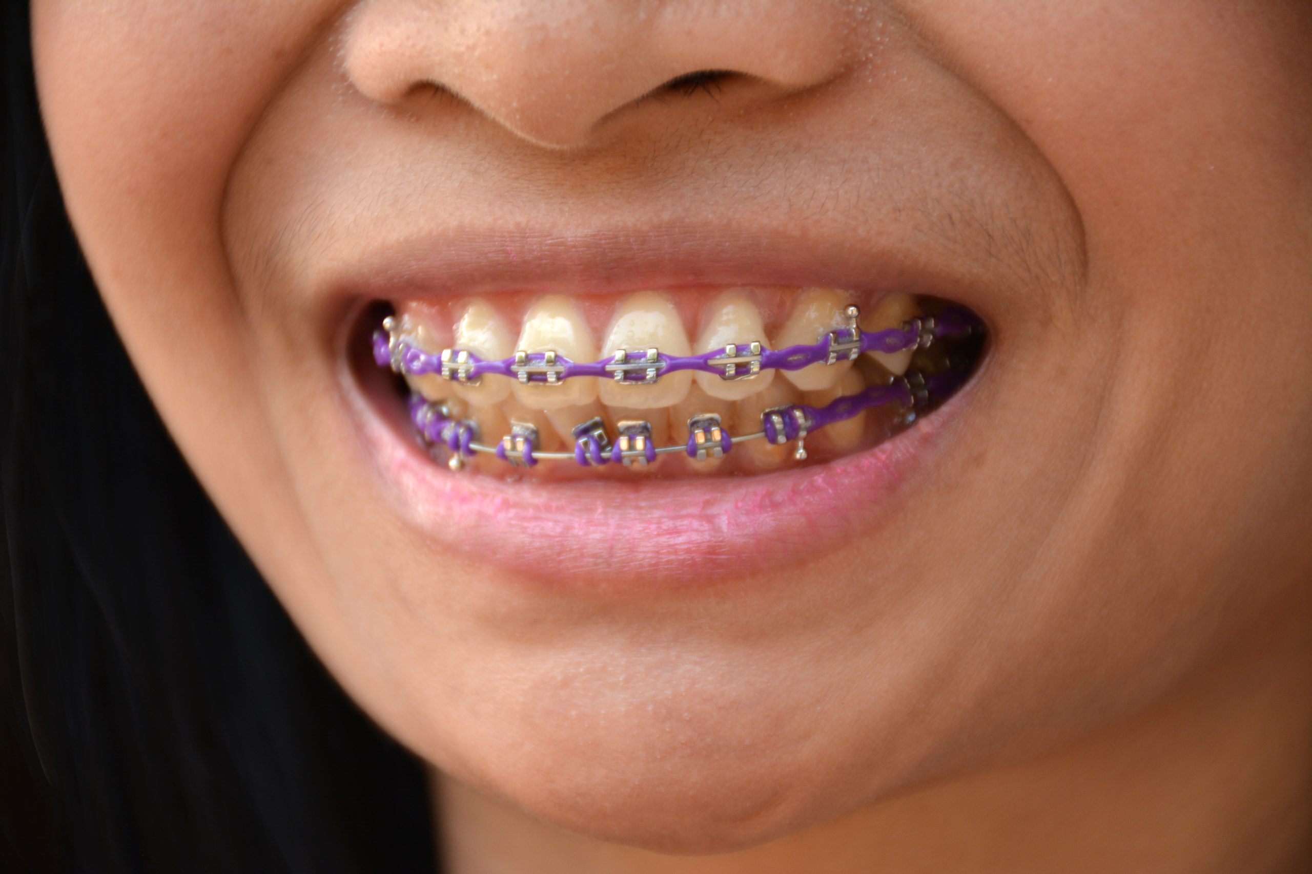 Braces Elastic Power chain in upper teeth