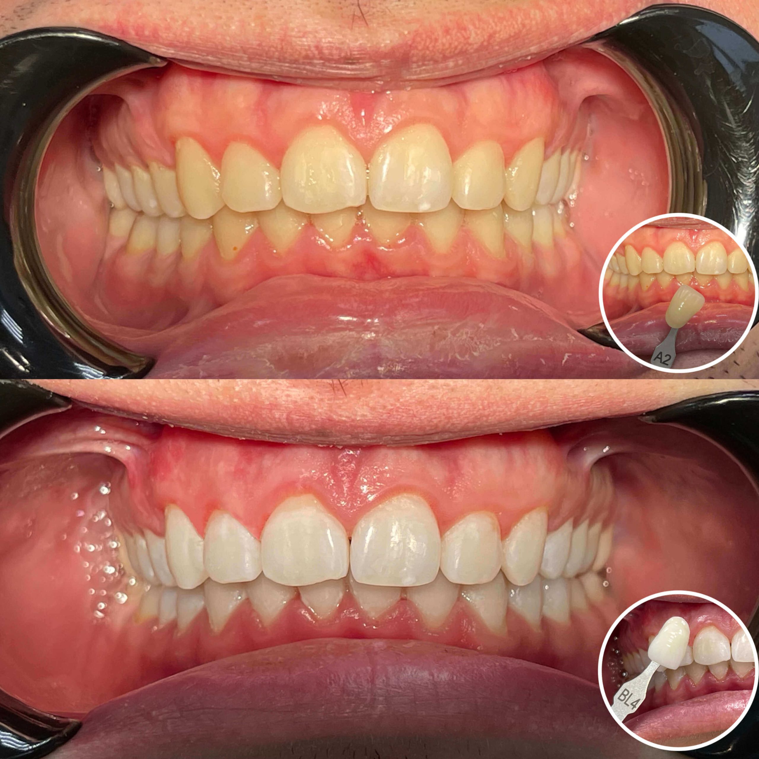 how to get rid of yellow teeth. Professional Teeth Whitening For Yellowish Teeth.