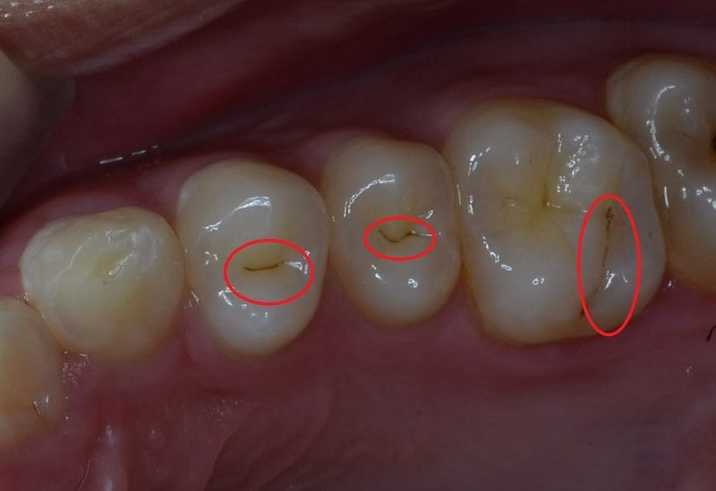 Proper oral hygiene and low sugar intake can reverse tooth decay in small crack and fissures