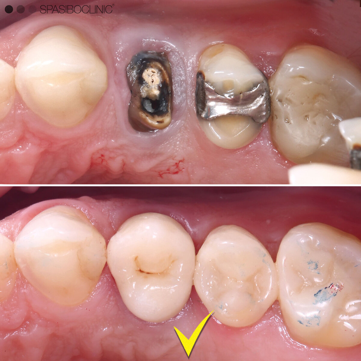 Repairing broken tooth with dental crowns