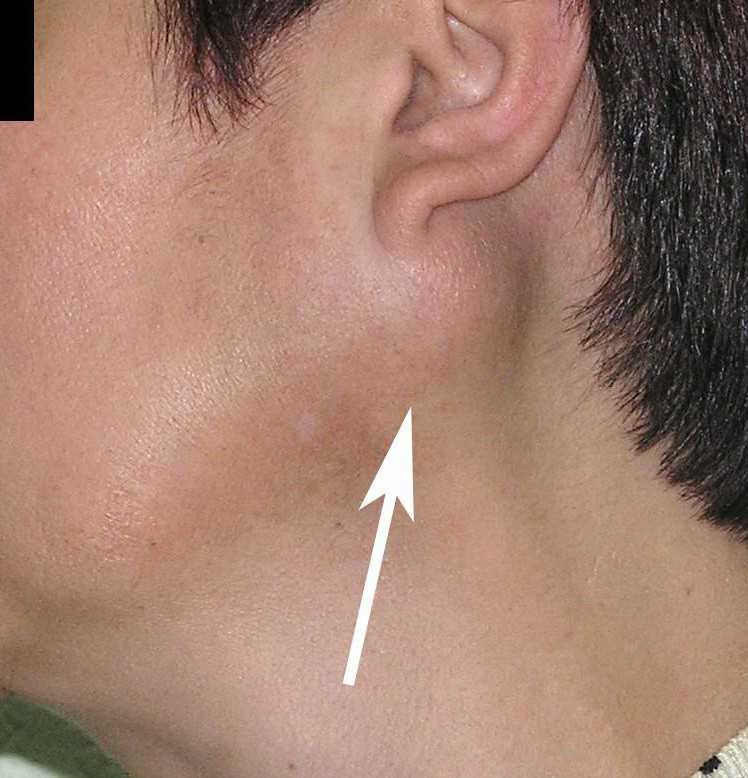 Salivary gland tumors-lump under jaw line left side