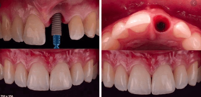 Same Day Dental Implants: The Ultimate Guide to Teeth in a Day