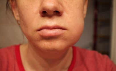 Swelling after tooth extraction-how to bring down swelling in face from tooth