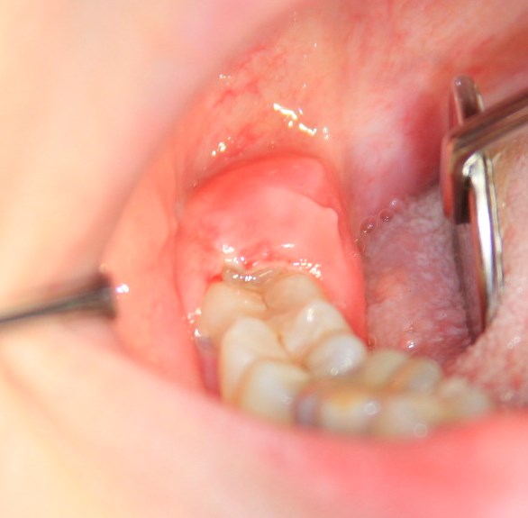 Swelling in gums at back of teeth due to wisdom tooth coming in can cause bad taste in mouth