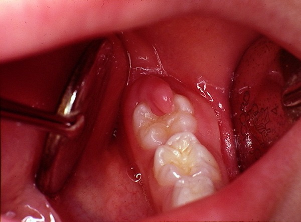 swollen gums in back of mouth, gums behind teeth swollen