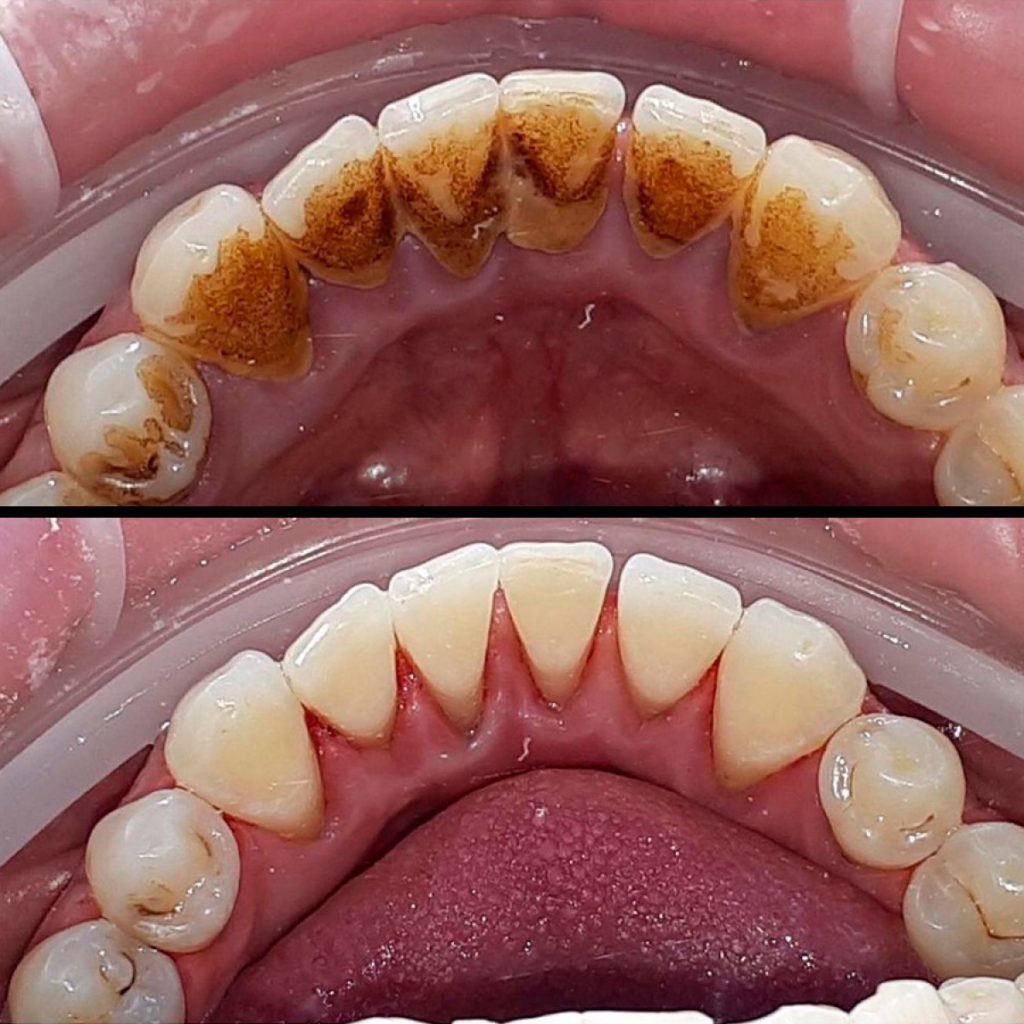 Tartar Breaking Off Teeth During Deep Cleaning