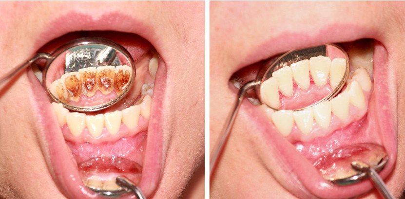 Tartar breaking off teeth at home or by with scaling is necessary for optimal gums health.