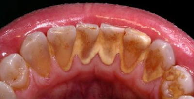 Tartar deposit at back of teeth which can break off easily during flossing or even brushing