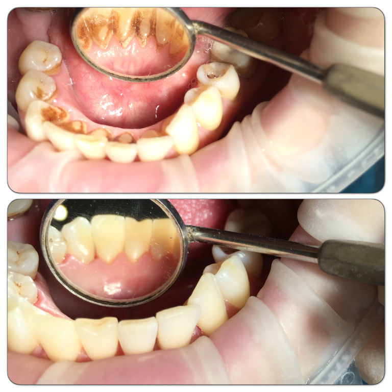 Tartar deposits at back of teeth commonly missed during toothbrushing.