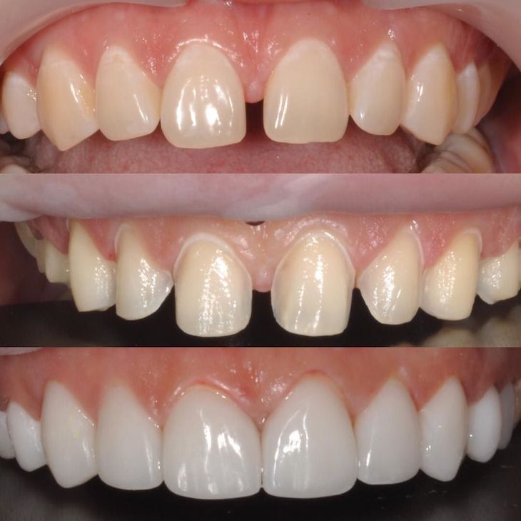 Teeth veneers on front teeth  veneers teeth, dental veneers, teeth underneath veneers, veneers for teeth, veneers process