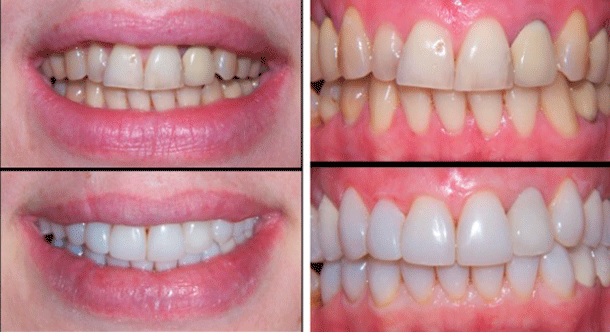 Teeth veneers for discolored teeth