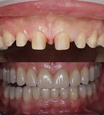 Teeth veneers for smile makeover