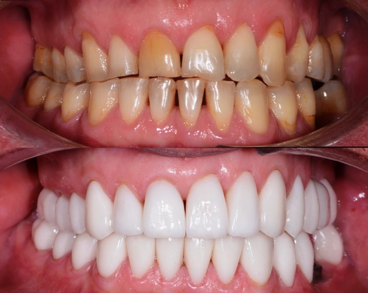 Teeth veneers for smile makeover