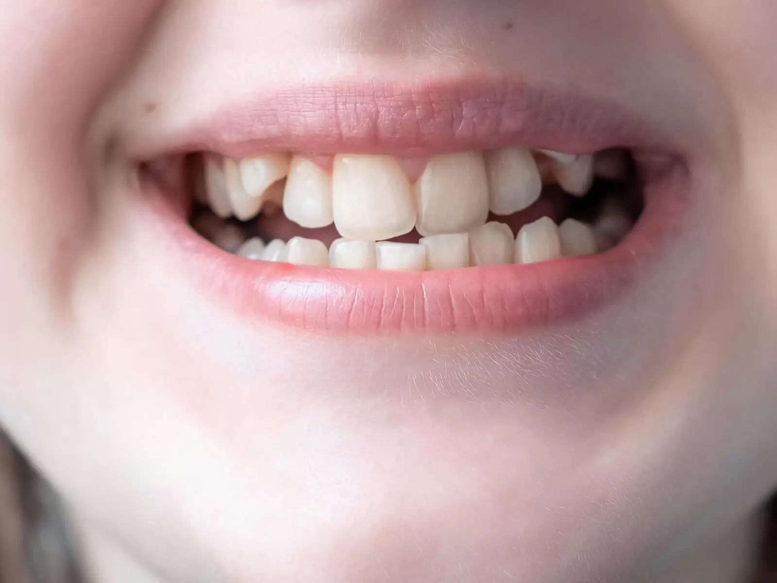 How Misaligned Teeth Affect Oral Health: Risks, Solutions, and Prevention