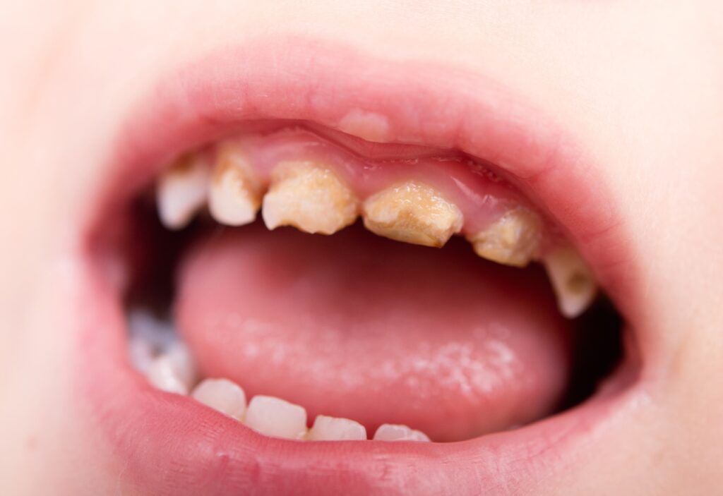 The Impact of Baby Bottle Tooth Decay: What Parents Need to Know