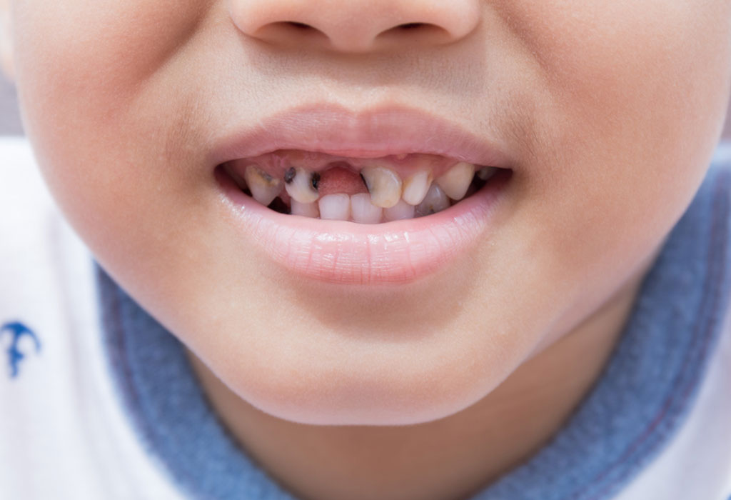 Rotten Teeth in Children: Causes, Prevention, and Treatment