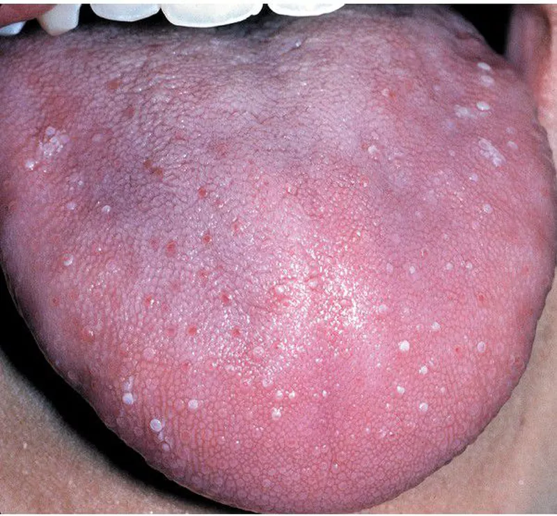 Transient-lingual-papillitis--bumps-in-back-of-tongue-pimple-in-tongue-lie-bump