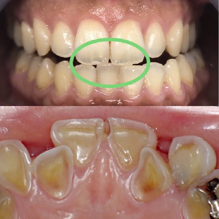 Translucent Teeth and Enamel Loss: What You Need to Know