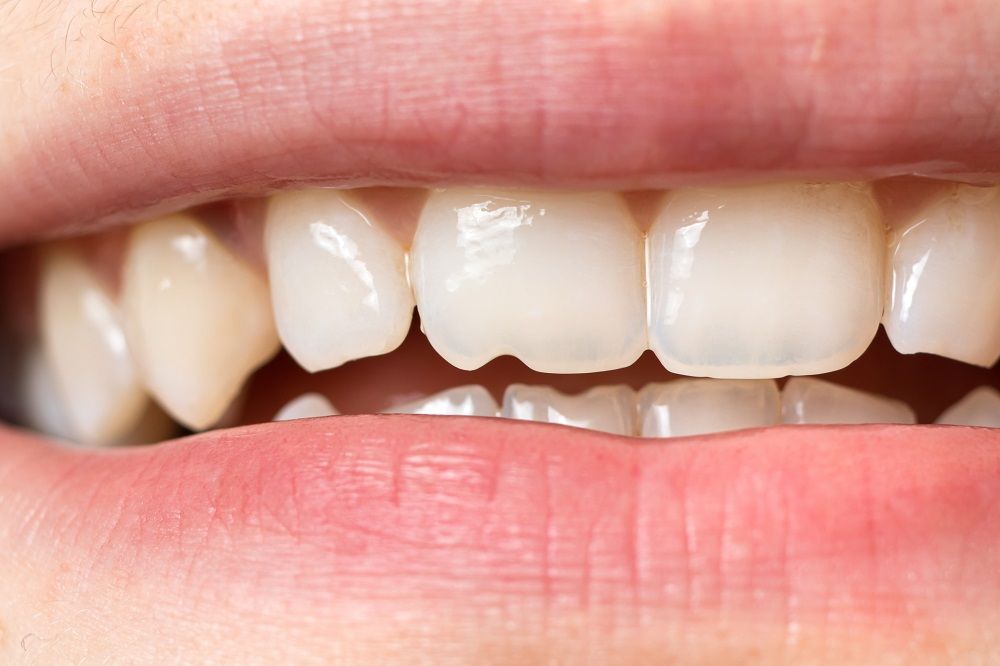 Best Dental Treatments for Restoring Translucent Teeth