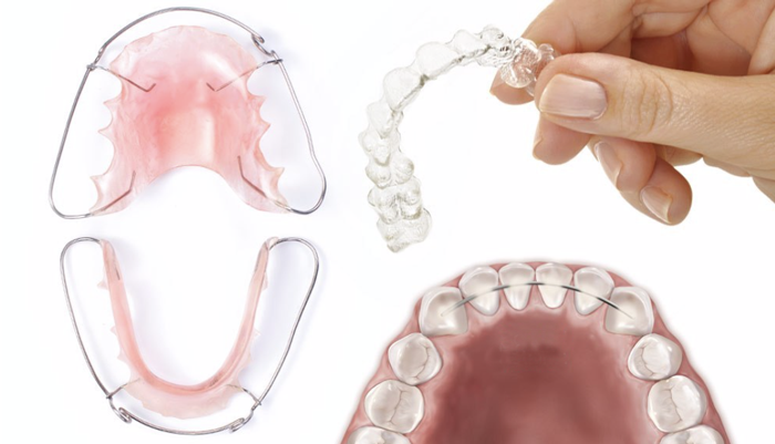 Types of Retainers After Braces: Hawley, Clear, and Wire Retainers Explained