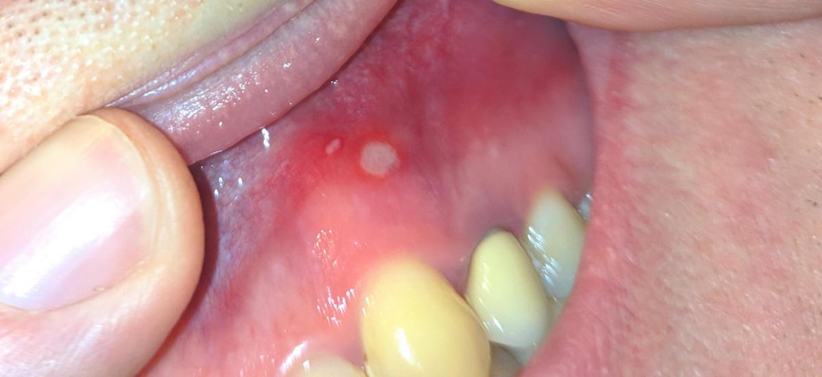 Understanding Holes in Gums: Causes, Symptoms, and Treatment Options for Optimal Oral Health