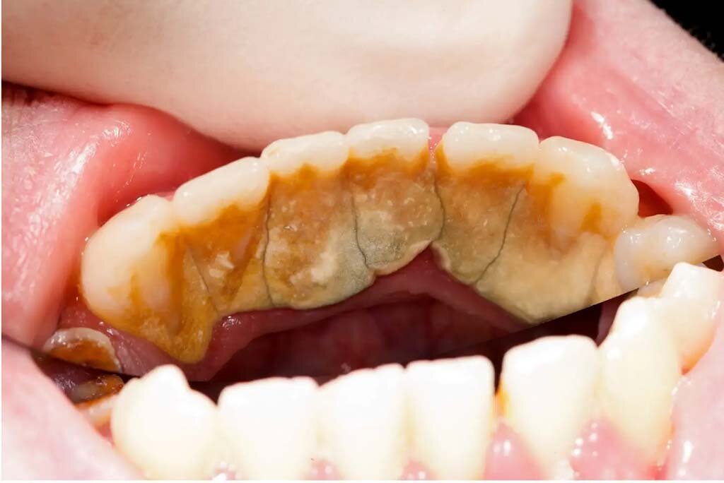 The Role of Plaque and Tartar Buildup in Rotten Teeth