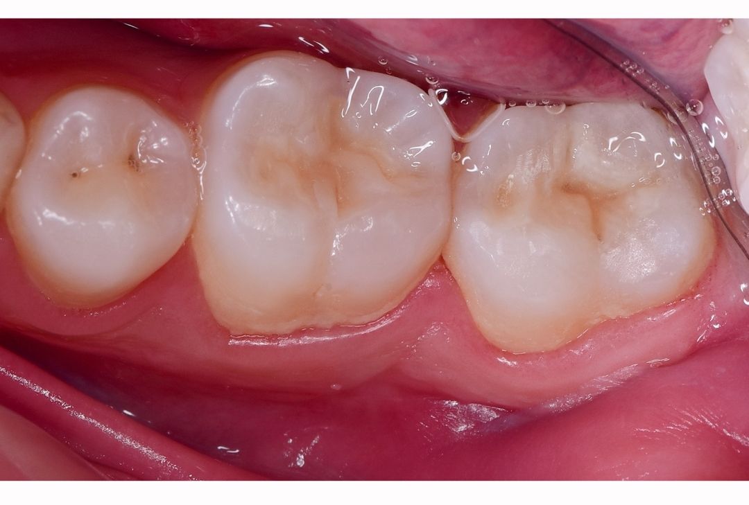 What Does a Cavity Look Like? A Complete Guide to Recognizing Tooth Decay